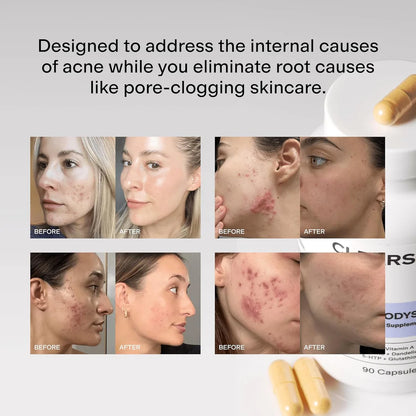 NUMI® Hormonal Acne Supplement